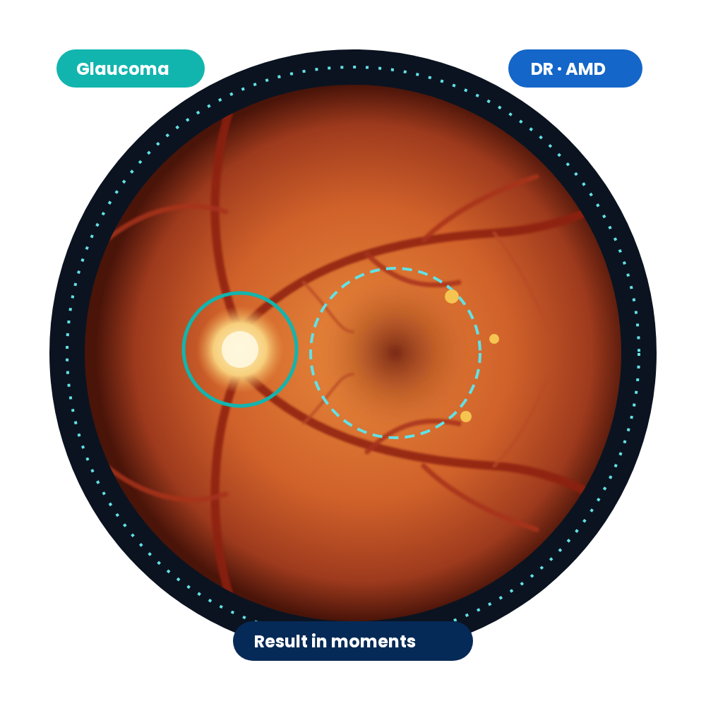 RetinaLyze AI analysing a retinal fundus photograph